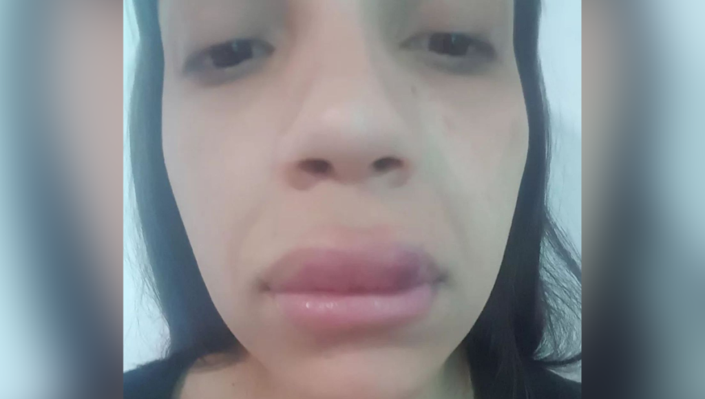 El drama de una joven de Laferrere: se le deformó el labio tras una cirugía, fue a reclamar al centro de estética y la echaron a golpes