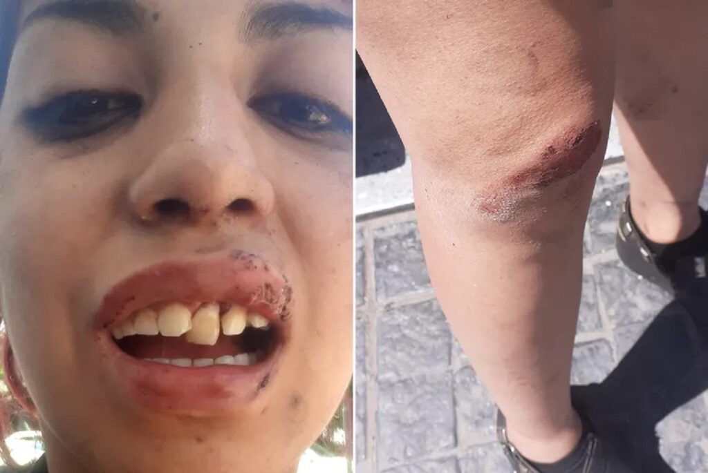 Indignante video a la salida de un boliche en Burzaco: un policía le dio un codazo a una joven y le fracturó la mandíbula