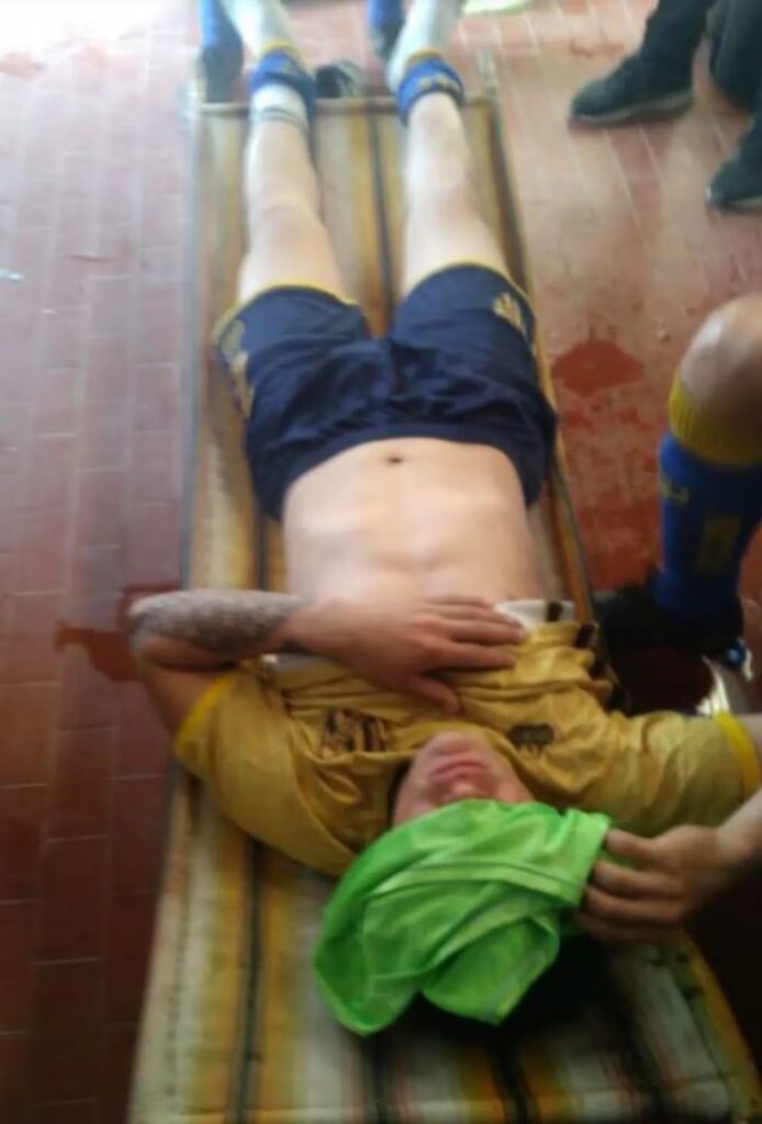 Un jugador de la Liga Amateur Platense fue agredido con agua hirviendo: cómo se dio el brutal ataque