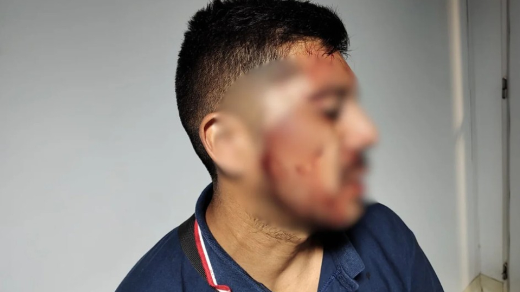 Lucas Ybarra, el chofer de la linea 378 de La Matanza que fue tajeado en la cara, hecho que disparó un paro sorpresivo de colectivos.